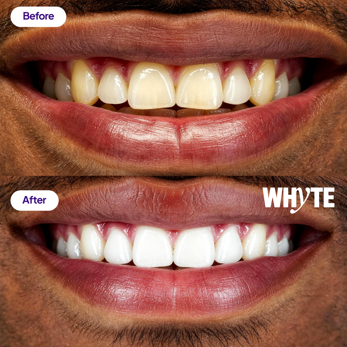 Purple Whitening Strips